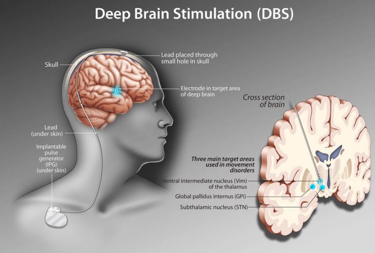 دراسة أمريكية: تقنية التحفيز العميق للدماغ قد تساعد في علاج السكتات الدماغية 1 0708DBS h2