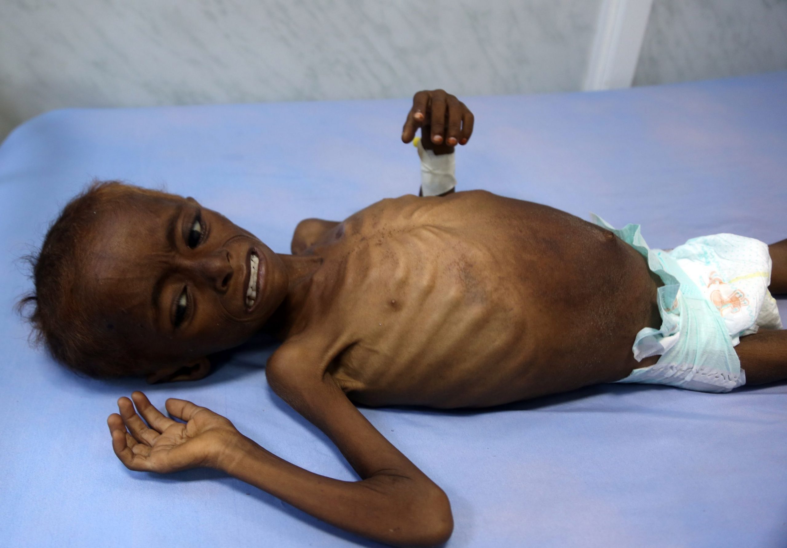 349356 أطفال اليمن يعانون من سوء التغذية1709144344 scaled
