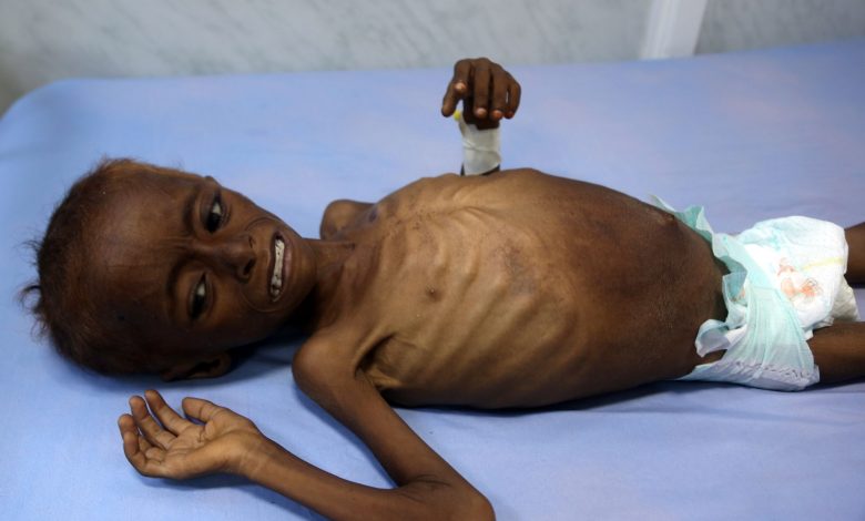 349356 أطفال اليمن يعانون من سوء التغذية1709144344
