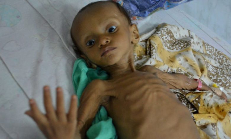 161008121740 children in the province are at risk of severe malnutrition 640x360 ap nocredit1713260644