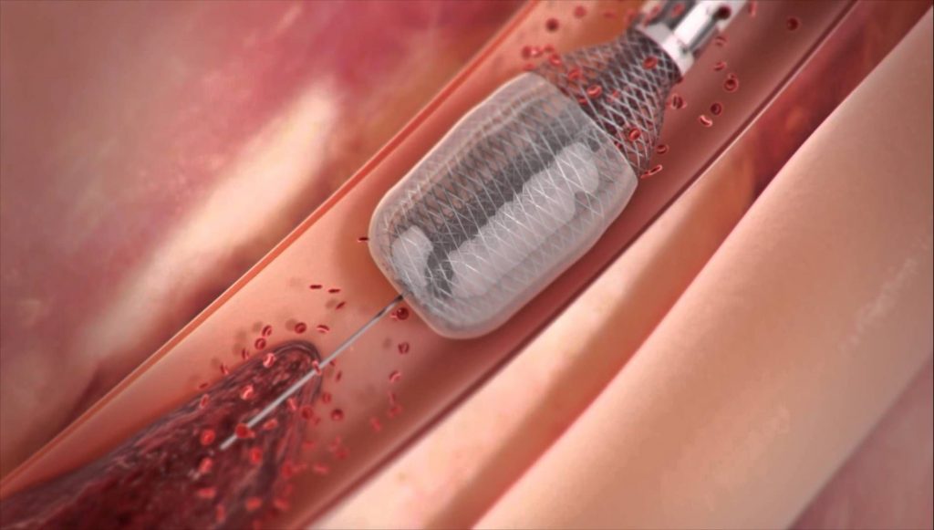جلوبال 3:نظام إزالة الجلطات المبتكر Aspiration Thrombectomy System من شركة Expanse ICE يحصل على موافقة إدارة الغذاء والدواء الأمريكية FDA لعلاج تجلطات الشرايين والأوعية الدموية الطرفية والأنظمة الوريدية 1 5e680ff2b62a90c0df4fad8dabf003f51713855607