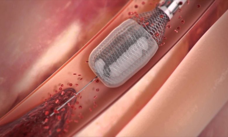 جلوبال 3:نظام إزالة الجلطات المبتكر Aspiration Thrombectomy System من شركة Expanse ICE يحصل على موافقة إدارة الغذاء والدواء الأمريكية FDA لعلاج تجلطات الشرايين والأوعية الدموية الطرفية والأنظمة الوريدية 1 5e680ff2b62a90c0df4fad8dabf003f51713855607