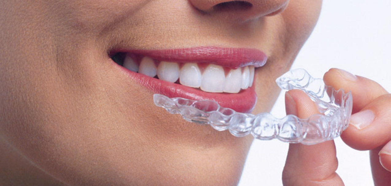 جلوبال (10): شركة Illusion Aligners تُسجل إنجازًا تاريخيًا بصنع أكبر تقويم أسنان في الهند 1 عيوب التقويم المستمر1717159683