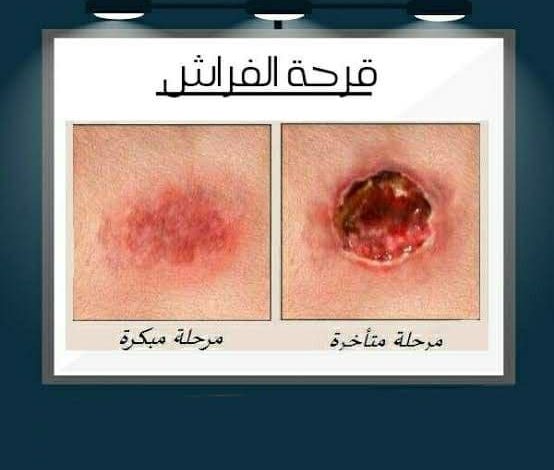 ضمن مبادرة "بديل المستورد "..قومي البحوث ينتج أقمشة بمواصفات خاصة لعلاج قرح الفراش 1 photo 2021 11 15 18 35 141720172103