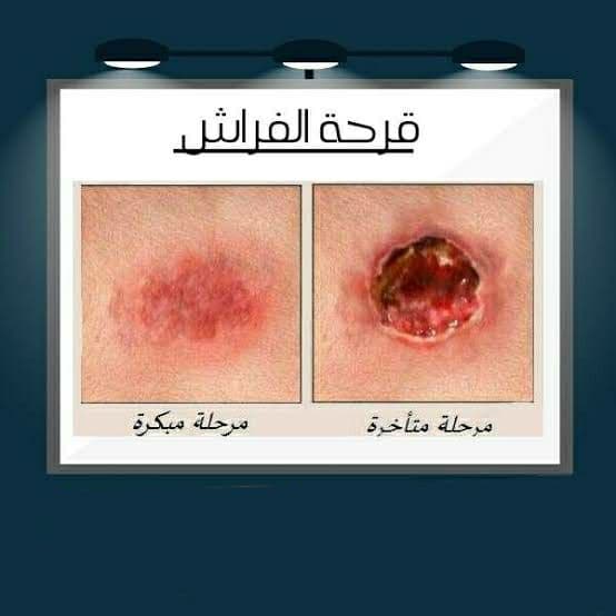 ضمن مبادرة "بديل المستورد "..قومي البحوث ينتج أقمشة بمواصفات خاصة لعلاج قرح الفراش 1 photo 2021 11 15 18 35 141720172103